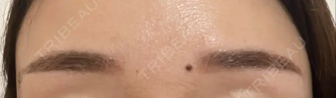 アートメイク（眉） 三鷹ヒロクリニック 北口院 （医療脱毛） DAY 5 メイン用