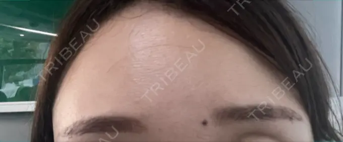 アートメイク（眉） 三鷹ヒロクリニック 北口院 （医療脱毛） AFTER メイン用