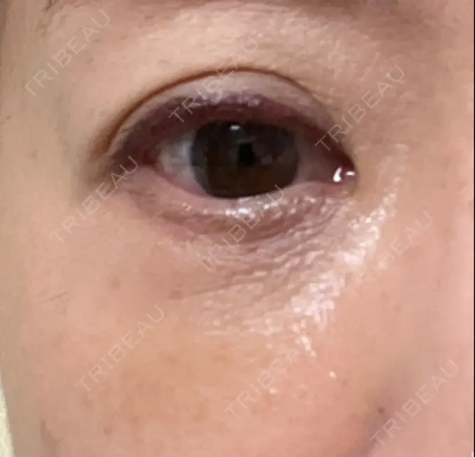 下まぶたの脂肪取り 東京イセアクリニック DAY 3 メイン用