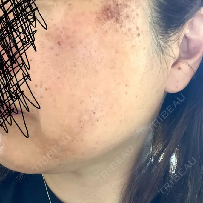 光治療（フォトフェイシャルなど） Wi Clinic（ウィ クリニック） 大宮院 DAY 4 メイン用