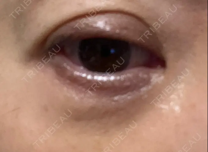 下まぶたの脂肪取り 東京イセアクリニック DAY 4 メイン用