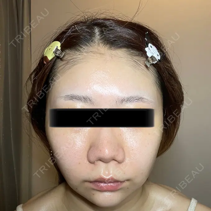 脂肪吸引（顔） / メーラーファット除去 / ボトックス（あご） / ヒアルロン酸注入（あご） / ボトックス（エラ・小顔） WOM CLINIC GINZA （ワム クリニック ギンザ） DAY 13 メイン用