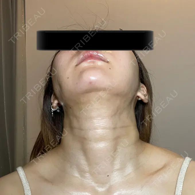 脂肪吸引（顔） / メーラーファット除去 / ボトックス（あご） / ヒアルロン酸注入（あご） / ボトックス（エラ・小顔） WOM CLINIC GINZA （ワム クリニック ギンザ） DAY 13 メイン用