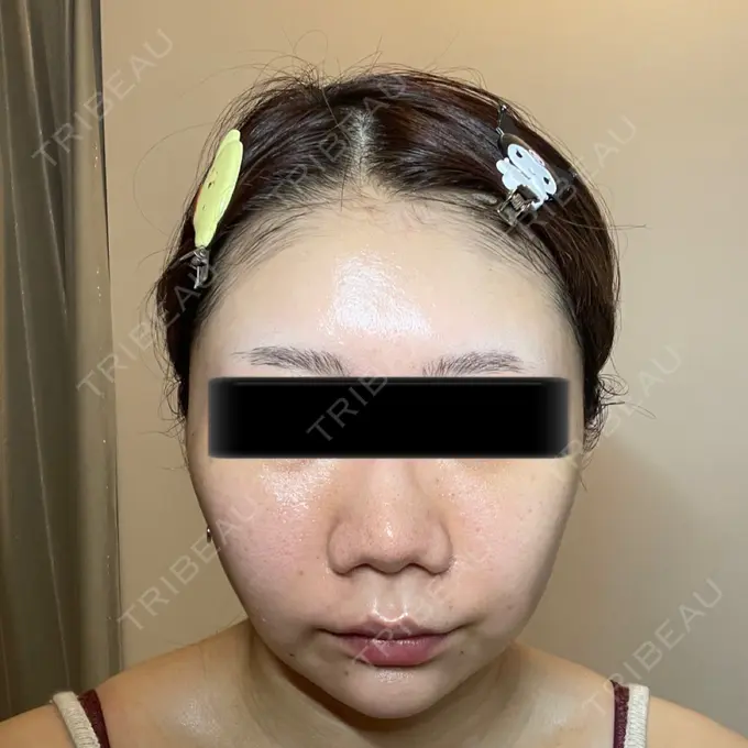 脂肪吸引（顔） / メーラーファット除去 / ボトックス（あご） / ヒアルロン酸注入（あご） / ボトックス（エラ・小顔） WOM CLINIC GINZA （ワム クリニック ギンザ） DAY 14 メイン用