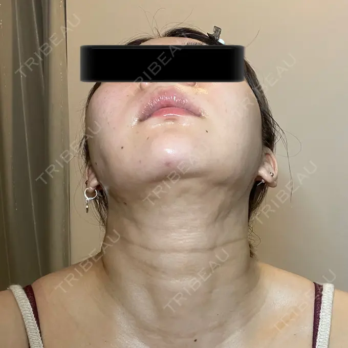 脂肪吸引（顔） / メーラーファット除去 / ボトックス（あご） / ヒアルロン酸注入（あご） / ボトックス（エラ・小顔） WOM CLINIC GINZA （ワム クリニック ギンザ） DAY 14 メイン用