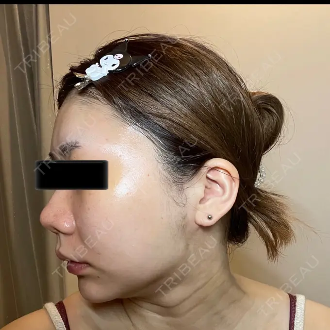 脂肪吸引（顔） / メーラーファット除去 / ボトックス（あご） / ヒアルロン酸注入（あご） / ボトックス（エラ・小顔） WOM CLINIC GINZA （ワム クリニック ギンザ） DAY 14 メイン用