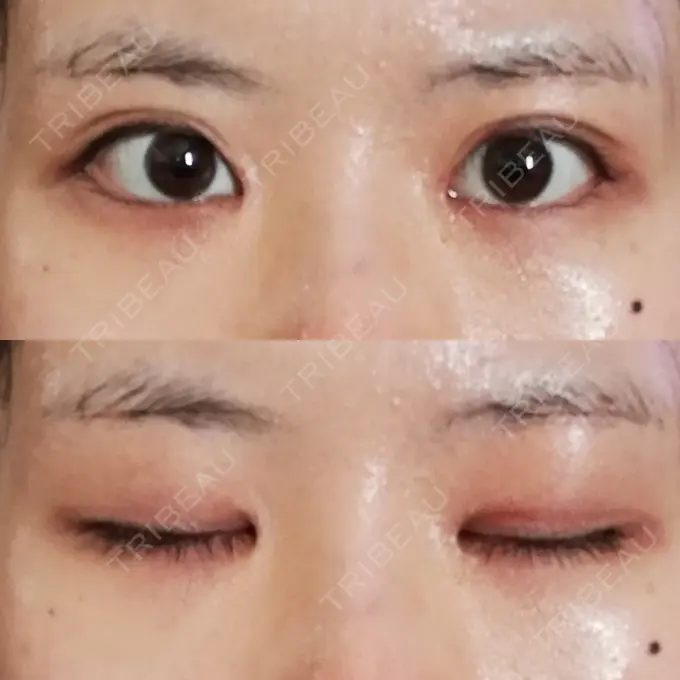 目頭切開 / 目尻切開 / 水光注射（ハリ・美肌） エートップ美容整形外科 DAY 21 メイン用