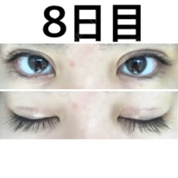 二重切開 みずほクリニック DAY 8 メイン用