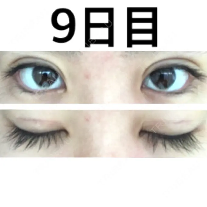 二重切開 みずほクリニック DAY 9 メイン用