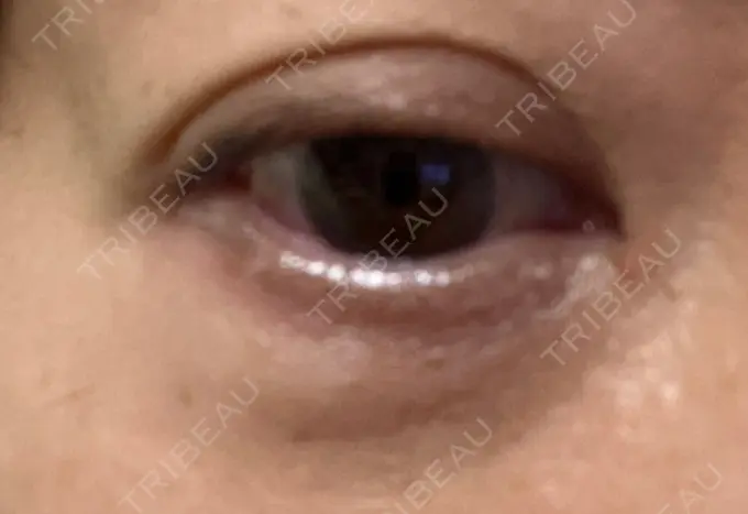 下まぶたの脂肪取り 東京イセアクリニック DAY 6 メイン用