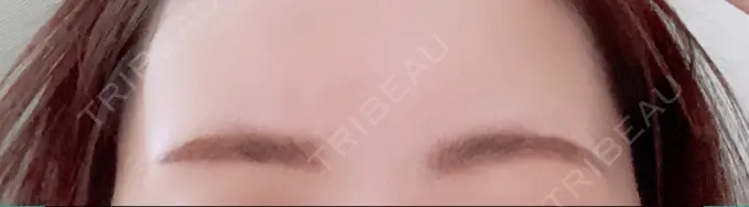 アートメイク（眉） 三鷹ヒロクリニック 北口院 （医療脱毛） DAY 0 メイン用