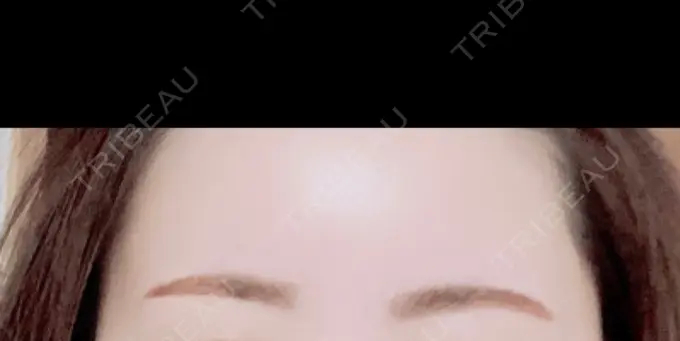 アートメイク（眉） 三鷹ヒロクリニック 北口院 （医療脱毛） DAY 1 メイン用