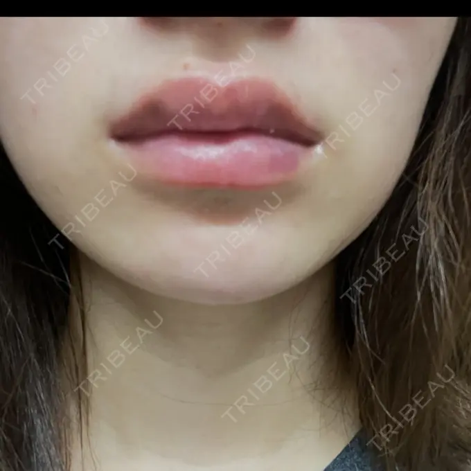 ボトックス（エラ・小顔） / ヒアルロン酸注入（唇） Dual Clinic SHINSAIBASHI DAY 2 メイン用