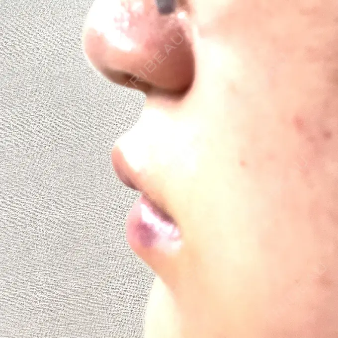 ボトックス（エラ・小顔） / ヒアルロン酸注入（唇） Dual Clinic SHINSAIBASHI DAY 2 メイン用