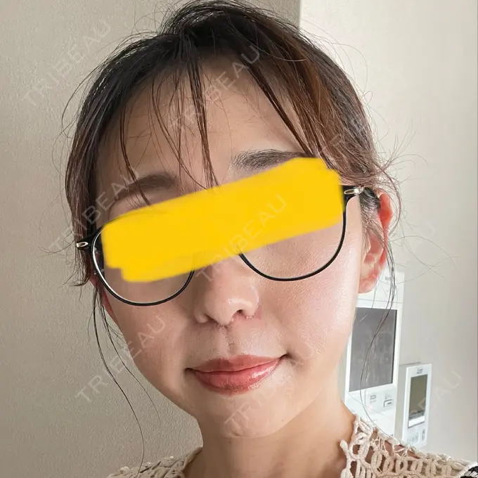 小鼻縮小（切開） / 鼻翼挙上 Otus Clinic 【オータスクリニック】 AFTER メイン用