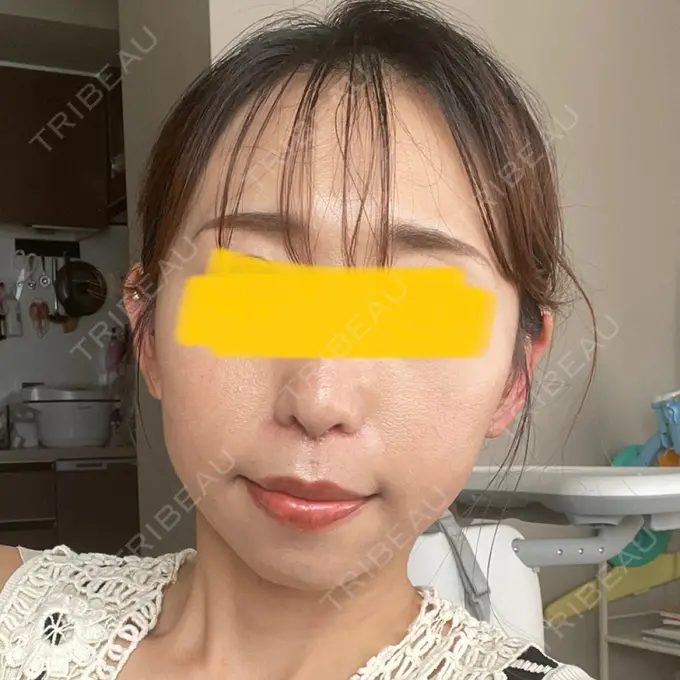 小鼻縮小（切開） / 鼻翼挙上 Otus Clinic 【オータスクリニック】 DAY 61 メイン用