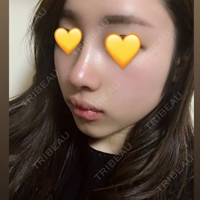 小鼻縮小（切開） / その他（鼻） FROM B整形外科 (旧バウム整形外科) DAY 10 メイン用