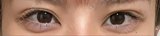 ヒアルロン酸注入（涙袋） フィラークリニック 町田院 AFTER メイン用