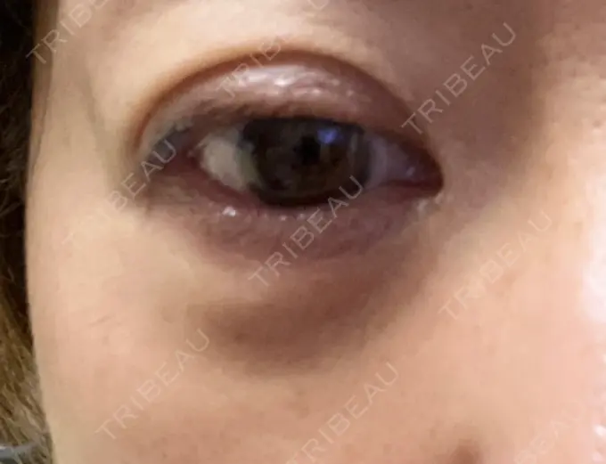 下まぶたの脂肪取り 東京イセアクリニック DAY 9 メイン用