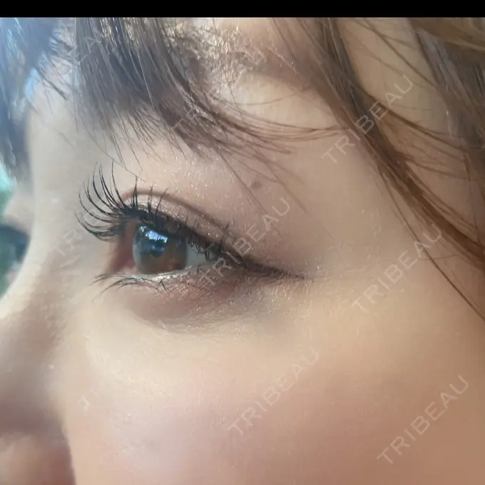 ボトックス（目尻） TCB東京中央美容外科 八王子院 AFTER メイン用