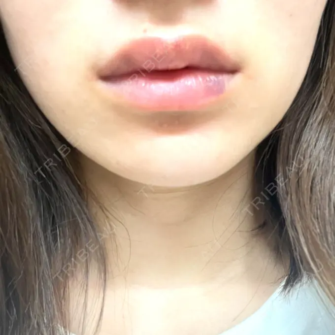 ボトックス（エラ・小顔） / ヒアルロン酸注入（唇） Dual Clinic SHINSAIBASHI DAY 3 メイン用