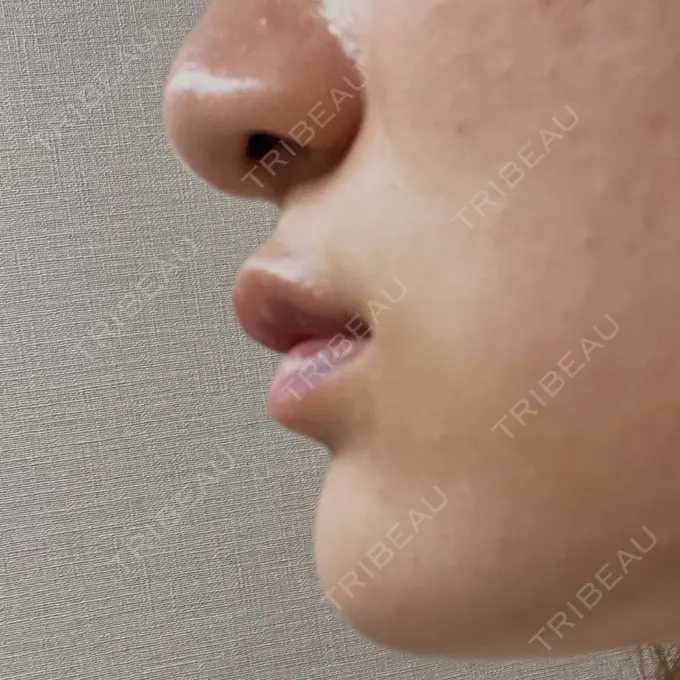 ボトックス（エラ・小顔） / ヒアルロン酸注入（唇） Dual Clinic SHINSAIBASHI DAY 3 メイン用