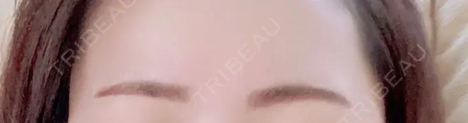 アートメイク（眉） 三鷹ヒロクリニック 北口院 （医療脱毛） DAY 2 メイン用