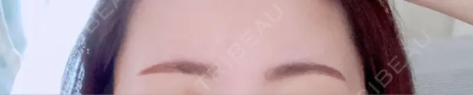 アートメイク（眉） 三鷹ヒロクリニック 北口院 （医療脱毛） DAY 3 メイン用