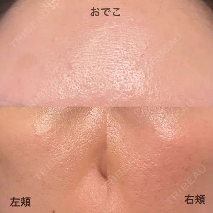 レーザーフェイシャル 石倉クリニック 水戸院 DAY 1 メイン用