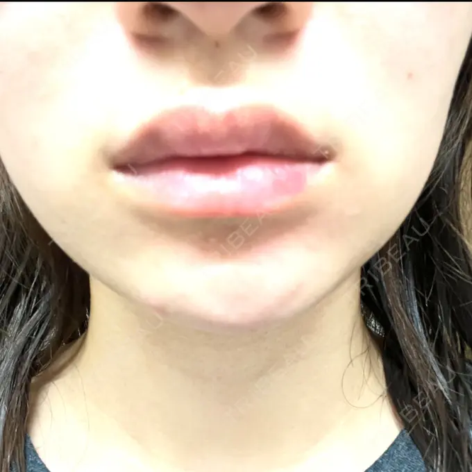 ボトックス（エラ・小顔） / ヒアルロン酸注入（唇） Dual Clinic SHINSAIBASHI AFTER メイン用