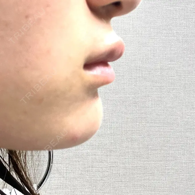 ボトックス（エラ・小顔） / ヒアルロン酸注入（唇） Dual Clinic SHINSAIBASHI DAY 4 メイン用