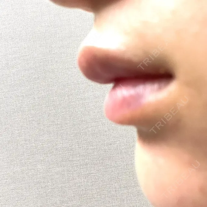 ボトックス（エラ・小顔） / ヒアルロン酸注入（唇） Dual Clinic SHINSAIBASHI DAY 4 メイン用