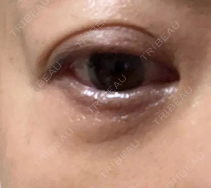 下まぶたの脂肪取り 東京イセアクリニック DAY 11 メイン用