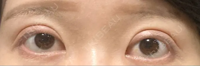 二重切開 / 目元修正 心斎橋コムロ美容外科クリニック DAY 258 メイン用