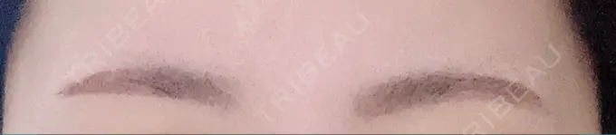 アートメイク（眉） 三鷹ヒロクリニック 北口院 （医療脱毛） DAY 5 メイン用