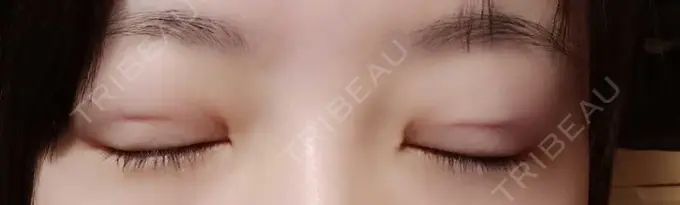 二重埋没 湘南美容クリニック 京都院 DAY 0 メイン用