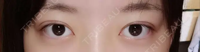 二重埋没 湘南美容クリニック 京都院 DAY 0 メイン用