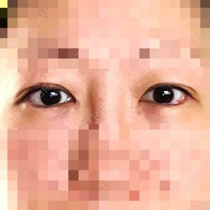 目尻切開 / タレ目形成・グラマラスライン（埋没） LOUIS CLINIC 二子玉川院【ルイクリニック】 DAY 2 メイン用