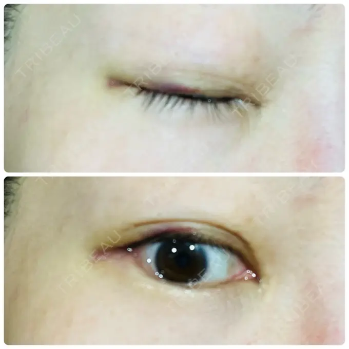 目尻切開 / タレ目形成・グラマラスライン（埋没） LOUIS CLINIC 二子玉川院【ルイクリニック】 DAY 2 メイン用