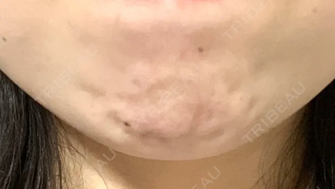 ボトックス（あご） フィラークリニック 町田院 DAY 1 メイン用