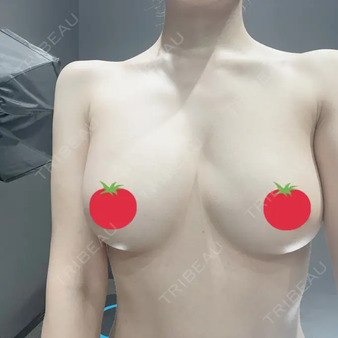 脂肪吸引（二の腕） / 脂肪吸引（脚） / 豊胸（脂肪注入） / 脂肪吸引（肩） Casa de GRACIA GINZA 【カーサデグラシアギンザ】 AFTER メイン用