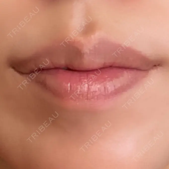 ボトックス（口角） アリエル美容クリニック 郡山院 DAY 17 メイン用