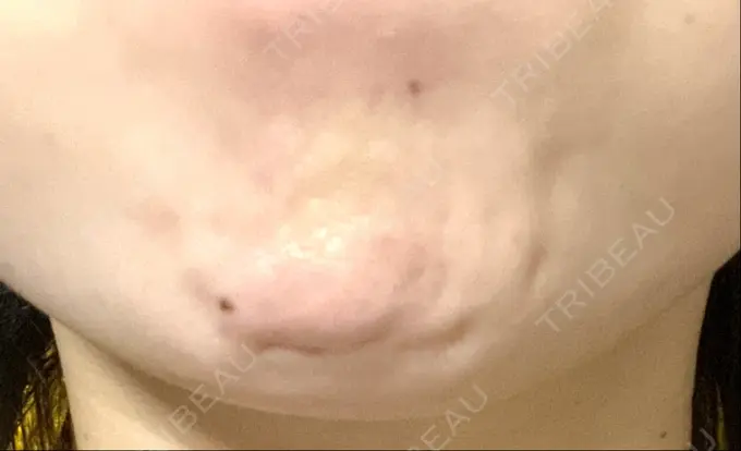 ボトックス（あご） フィラークリニック 町田院 DAY 2 メイン用