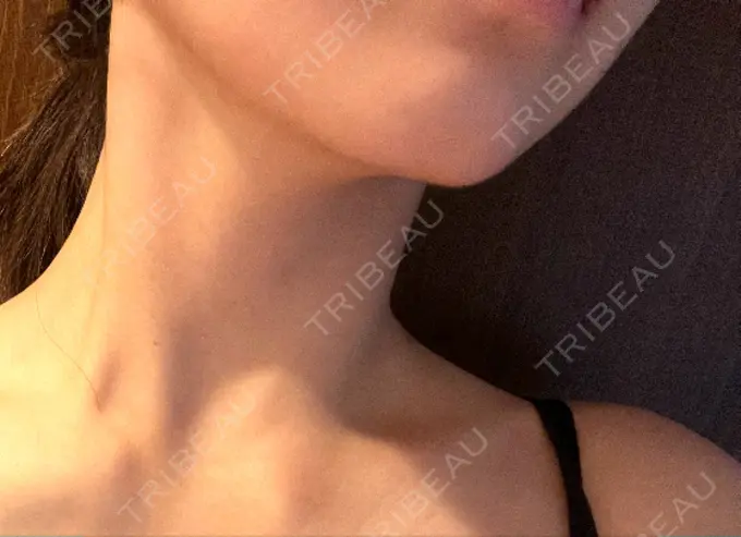 ハイフ（顔） HAAB BEAUTY CLINIC 横浜院 AFTER メイン用