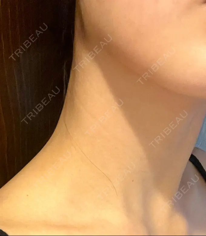 ハイフ（顔） HAAB BEAUTY CLINIC 横浜院 DAY 49 メイン用