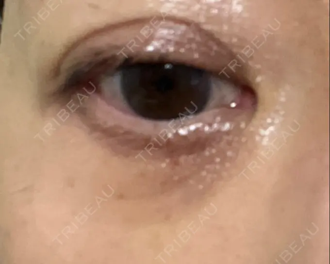 下まぶたの脂肪取り 東京イセアクリニック DAY 15 メイン用