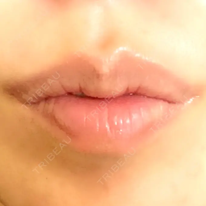 ボトックス（口角） アリエル美容クリニック 郡山院 AFTER メイン用