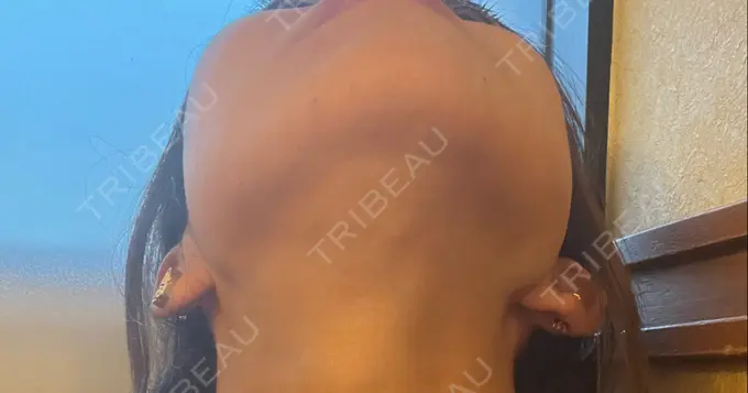 脂肪溶解注射（顔） ルラ美容クリニック 神戸院 DAY 4 メイン用