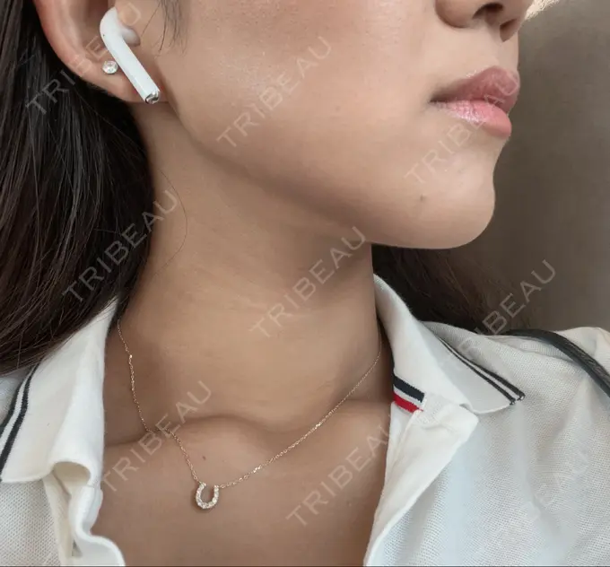 脂肪溶解注射（顔） ルラ美容クリニック 神戸院 DAY 29 メイン用