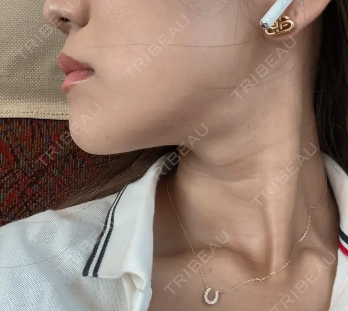 脂肪溶解注射（顔） ルラ美容クリニック 神戸院 DAY 29 メイン用